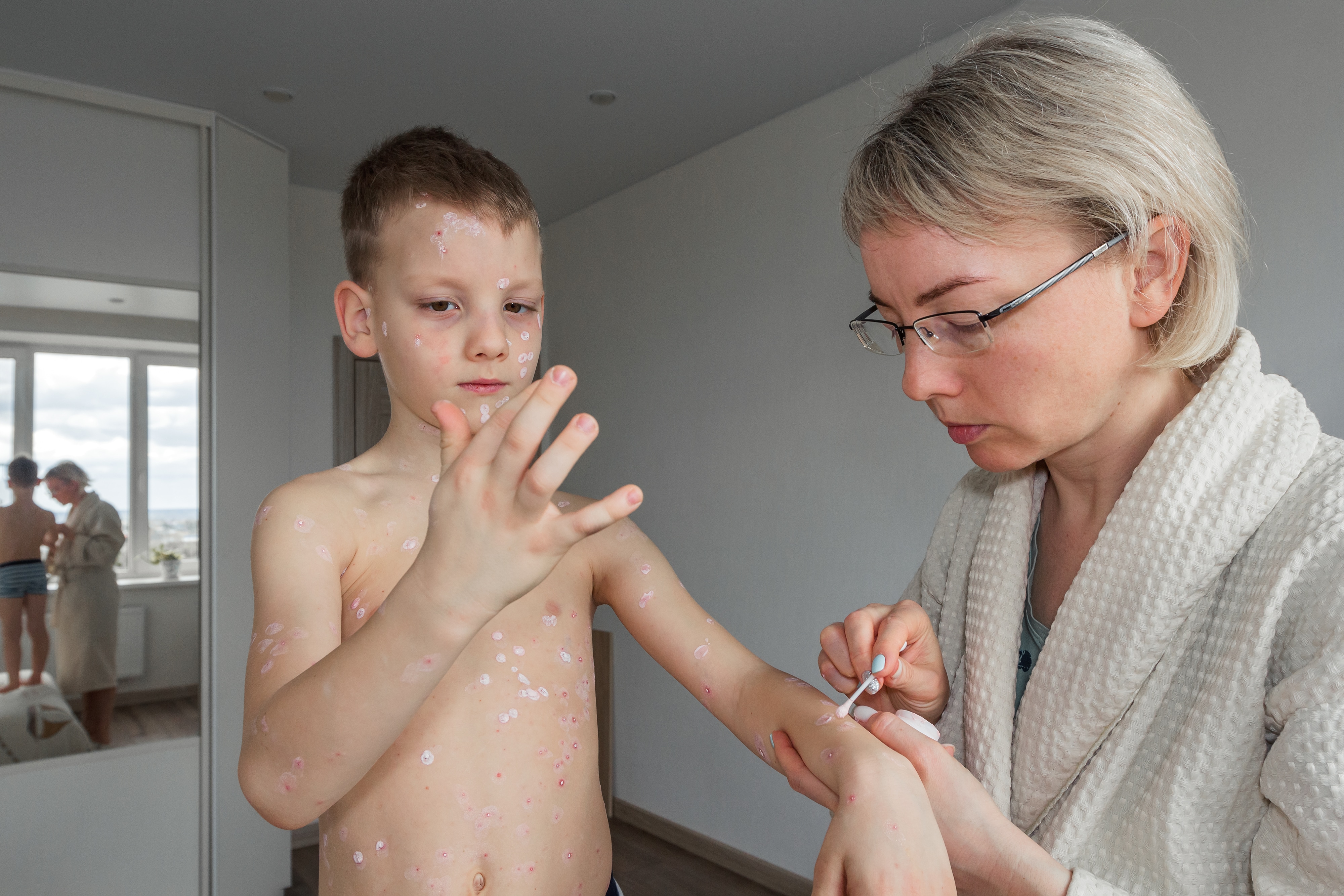 Chickenpox to Blame for £24 Million Lost Yearly in Income and Productivity
